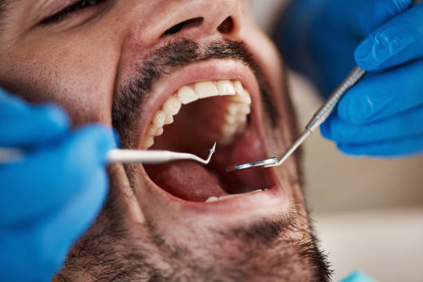 Best Emergency Dentist for Lost Fillings or Crowns in Saylorville, IA